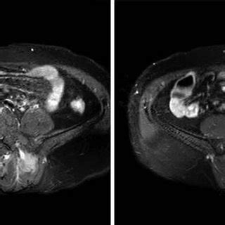 Magnetic Resonance Imaging MRI Of The Sacroiliac Joints Showed