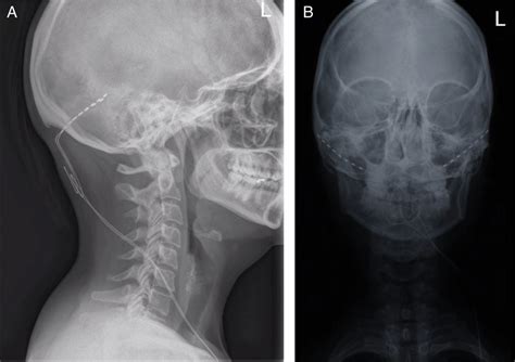 Skull X-rays showing occipital nerve stimulation electrode placement.... | Download Scientific ...