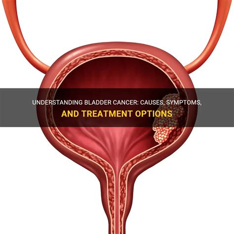 Understanding Bladder Cancer Causes Symptoms And Treatment Options