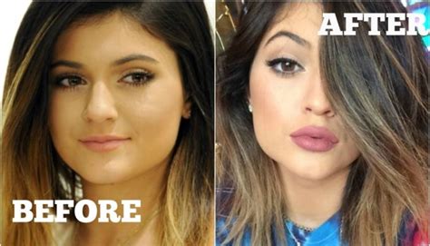 Lip Injections How To Get Kylie Jenner Lips