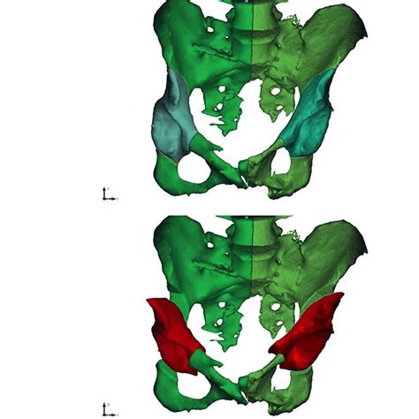 Patient Personalized 3 D Based Virtual Pre Operative Planning 3d Model Download Scientific