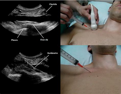 Figure 2 From Ultrasound Guided Subclavian Vein Cannulation Using A