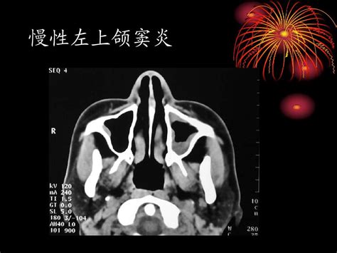 鼻和鼻窦病变ct诊断word文档在线阅读与下载无忧文档