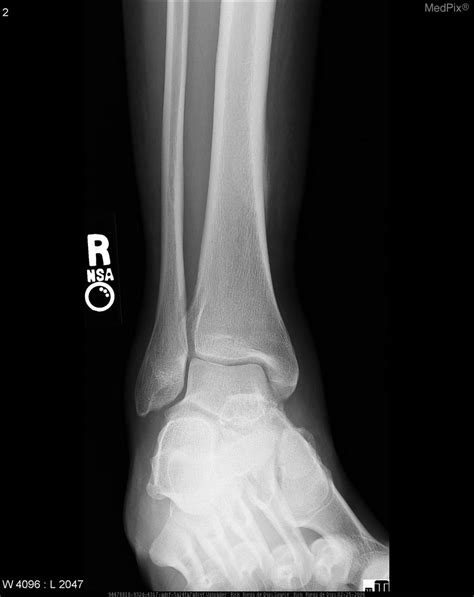 Stress Fracture Fibula X Ray