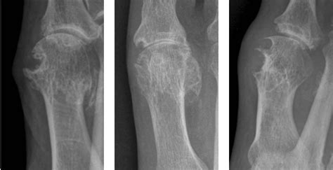 Gout Classification Calculator