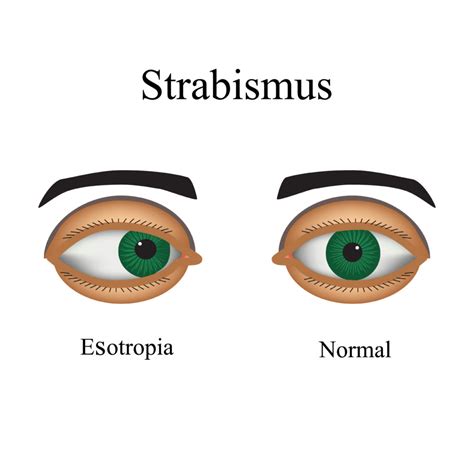 Treatment Of Strabismus Globehealer