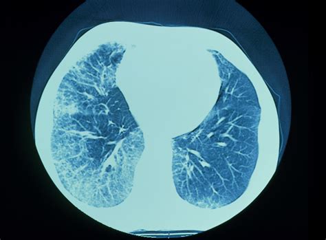 Nintedanib For Idiopathic Pulmonary Fibrosis Real World Outcomes