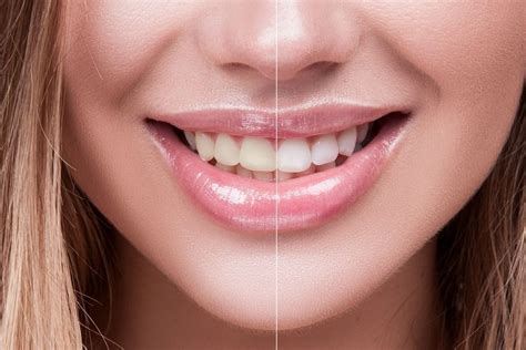 How To Remove Stains From Dental Bridges