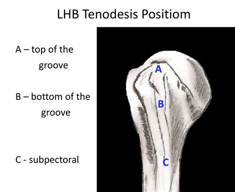 Long Head Of Biceps Cambridge Shoulder