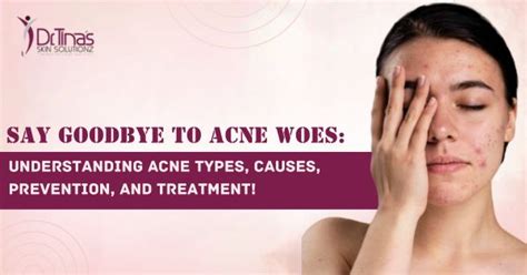 Acne 101 A Comprehensive Guide To Understanding Acne Types Causes Prevention And Treatment