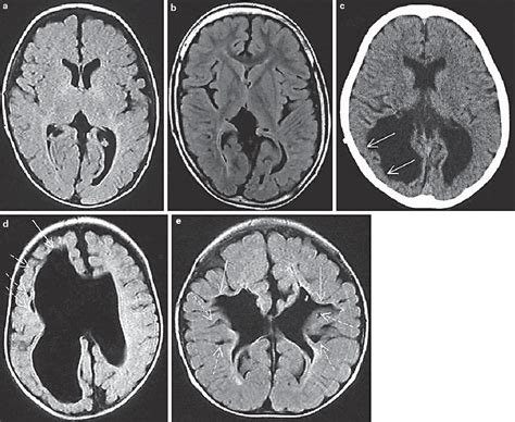 Fetal Germinal Matrix And Intraventricular Hemorrhage Semantic Scholar