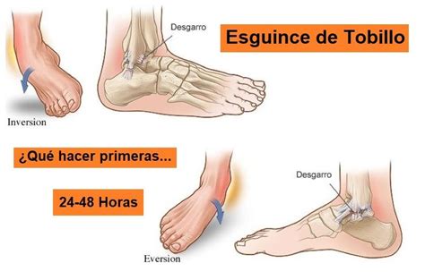 Qué hacer para curar esguince de tobillo Vídeo PadelStar