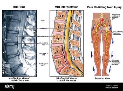 Low Back Pain - L4-5 and L5-S1 Lumbar Injuries Stock Photo, Royalty ...