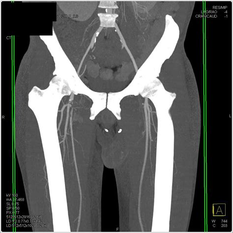 Femoral Artery Occlusion