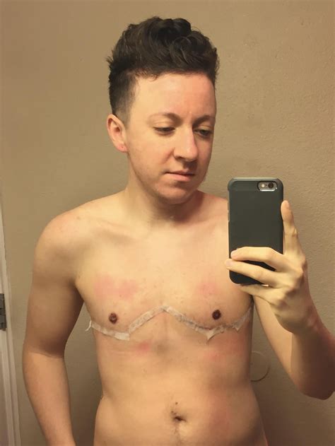 Current Chest Status 5 Years 4 Months Apart Double Incision With Free Nipple Grafts By Dr