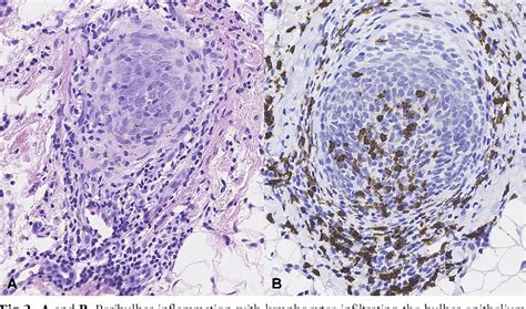 Figure From Paraneoplastic Alopecia Areata Surrounding A Low Grade