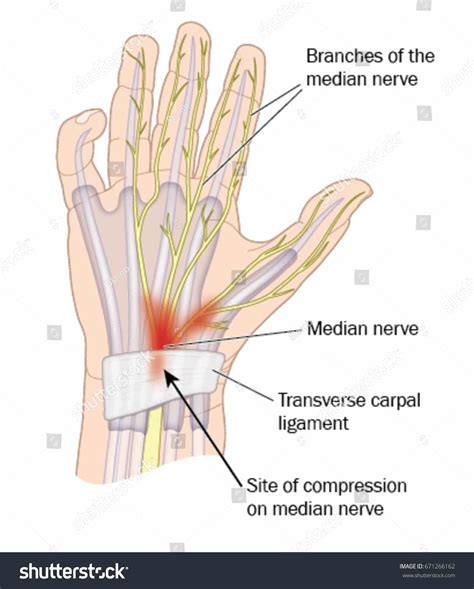 How Doctors Diagnose Carpal Tunnel Elite Carpal Tunnel