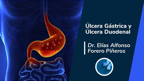 Lcera G Strica Y Lcera Duodenal C Mo Tratarla Dr El As Forero