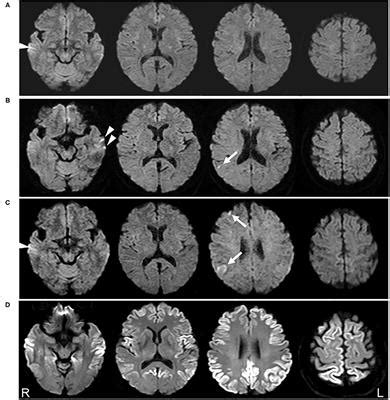 Frontiers Case Report Extremely Early Detection Of Preclinical