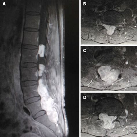 Gadolinium Enhanced T Weighted Magnetic Resonance Imaging At