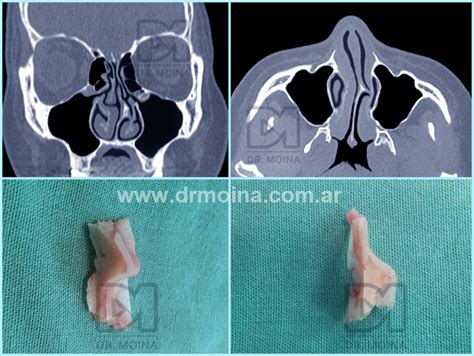 Rinoseptumplastia Cresta O Espol N De Tabique O Septum Nasal