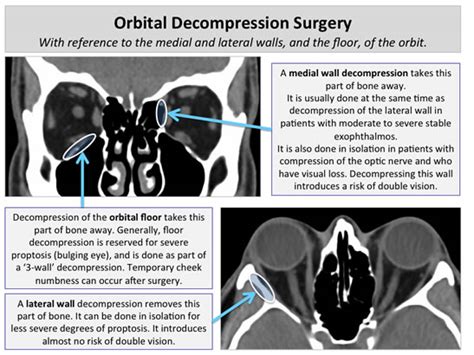 Thyroid Eye Disease Clinical Features Imaging And Surgery The Dh