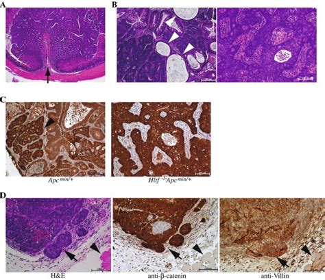 Hltf Apcmin Mice Develop Malignant Colon Tumors That Are