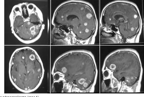 Figure 1 From Role Of Stereotactic Biopsy In Histological Diagnosis Of Multiple Brain Lesions