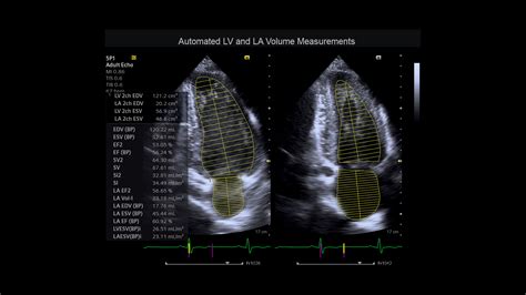 Acuson Juniper Cv Edition Ultrasound System Siemens Healthineers Usa