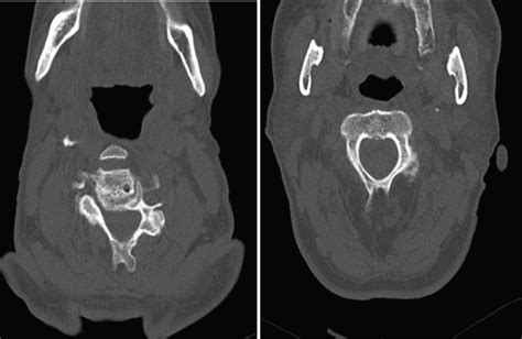 Unusual Site Of Yellow Ligament Ossification Cervical Spine