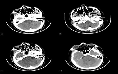 Shows near total resolution of the infarct noted in the right ...