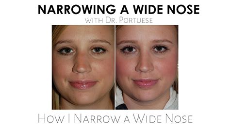 Narrowing Wide Nose Rhinoplasty Youtube