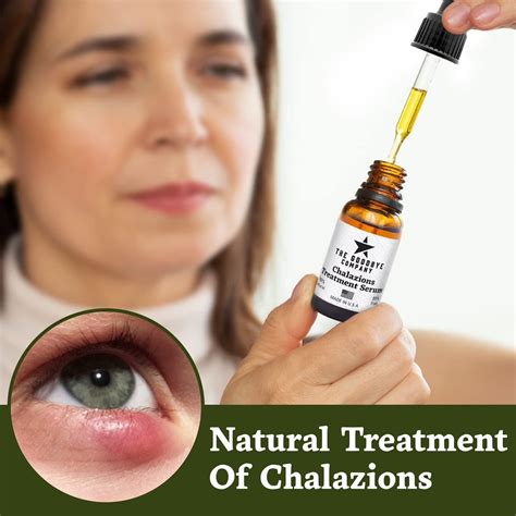 Chalazion Remover And Stye Eye Treatment Usa Made 15ml