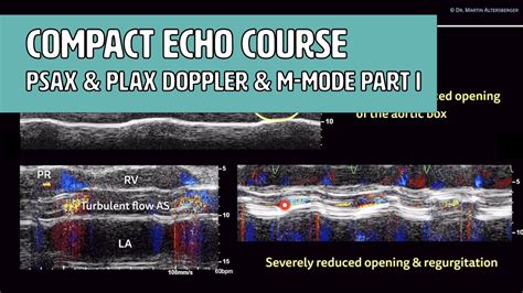 〖echocardiography〗 Psax And Plax Doppler And M Mode Measurements Youtube