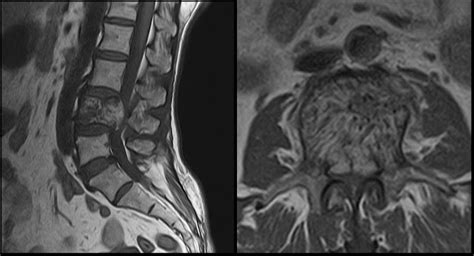 Ultimate Radiology : Aggressive ('Malignant') Hemangioma of Vertebrae