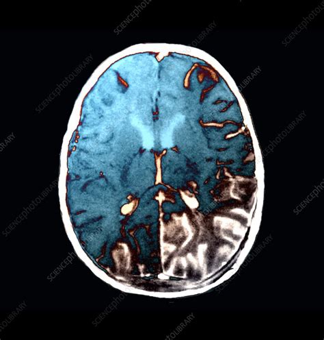 Brain In Meningitis Ct Scan Stock Image C0267942 Science Photo Library