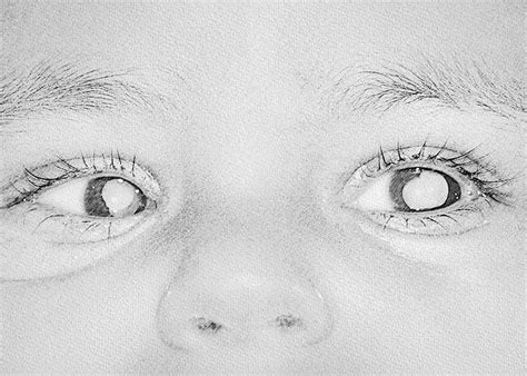 Retinopathy Of Prematurity Retyne