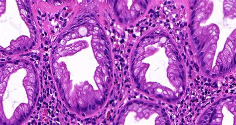 Rectal Polyp Histology