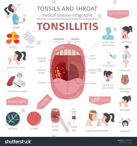 257 Tonsillectomy Images Stock Photos And Vectors Shutterstock