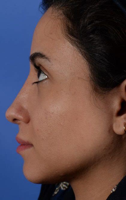 Patient 2039 Ethnic Rhinoplasty Before And After Photos Englewood