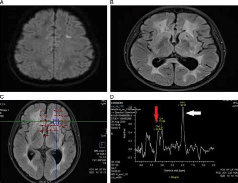 Magnetic Resonance Imaging Brain Showing Diffusion Restriction In The