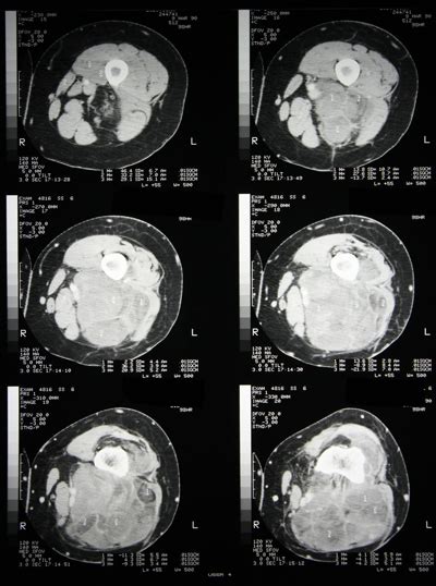 Leg Mri Two Views