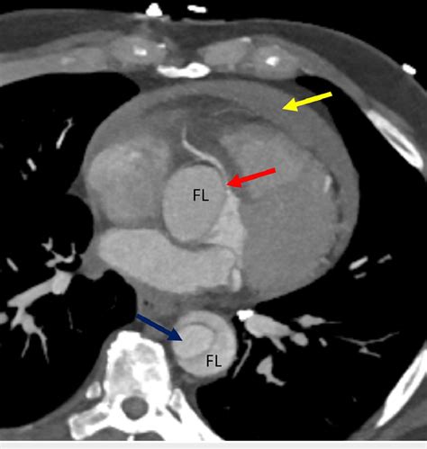 Axial section showing ascending thoracic aorta dissection sparing the... | Download Scientific ...