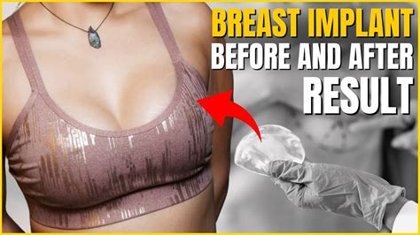 375cc Silicone Breast Implant result - YouTube