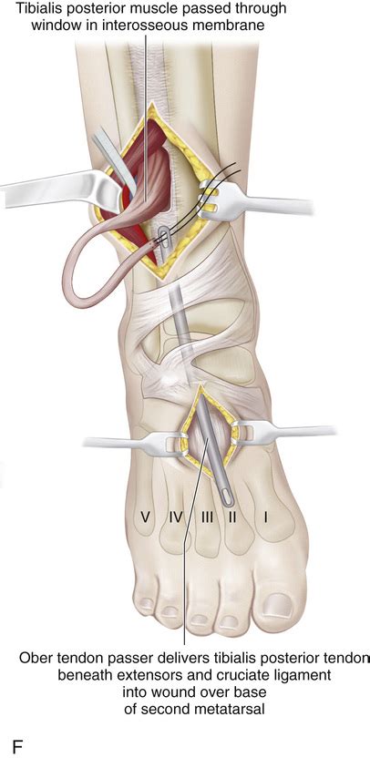 28 Anterior Transfer Of The Posterior Tibial Tendon Through The