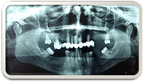 Figure 3 From Influence Of Bacteria And Dental Root Canal Ph On Maxillary Radicular Cysts