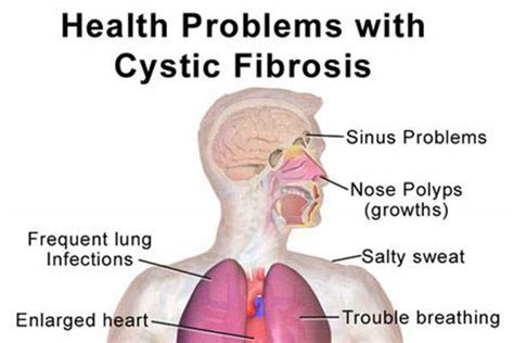 Orkambi Lumacaftor Ivacaftor For The Treatment Of Cystic Fibrosis Cf