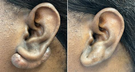 How To Safely Remove Keloid From Ear Piercings