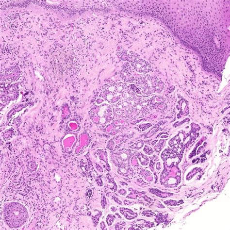 Pdf Adenoid Cystic Carcinoma Of The Base Of The Tongue Metastasizing To The Scalp