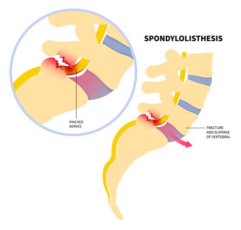 Isthmic Spondylolisthesis: Insights from a Leading Pain Management ...